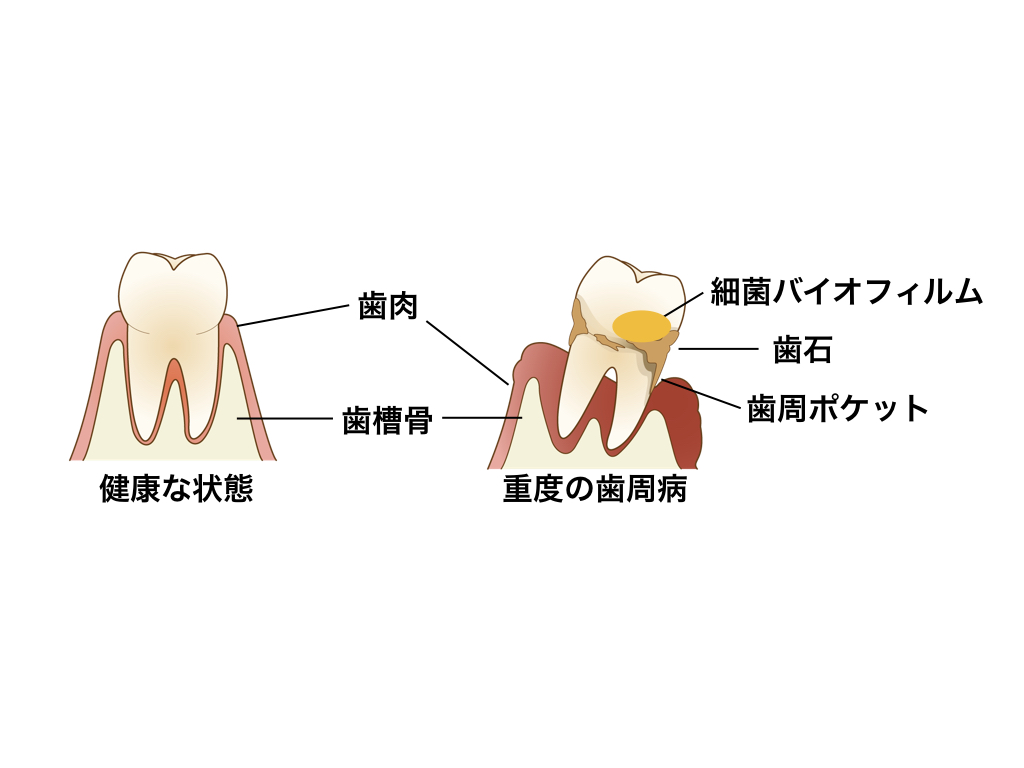 健康な状態と重度の歯周病